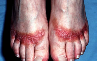 Contact Eczema Pictures