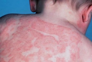 Infant Eczema