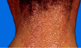 Neurodermatitis Pictures